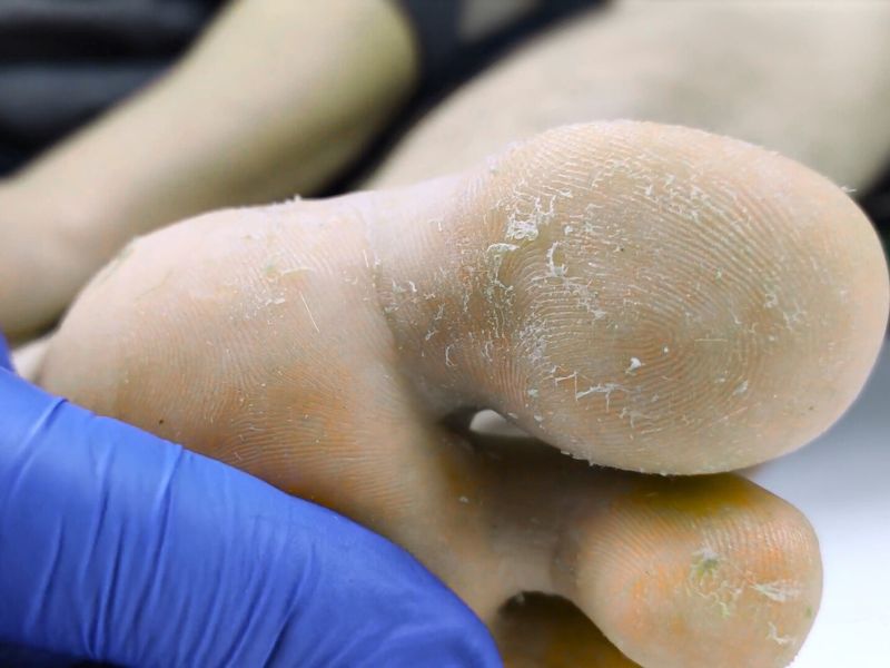 Osoba na pregledu kod lekara za atletsko stopalo